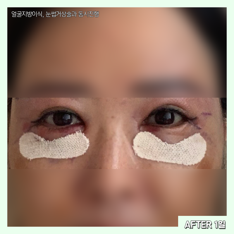 미니하안검붓기 궁금하셨다구요? 관련 이미지 3