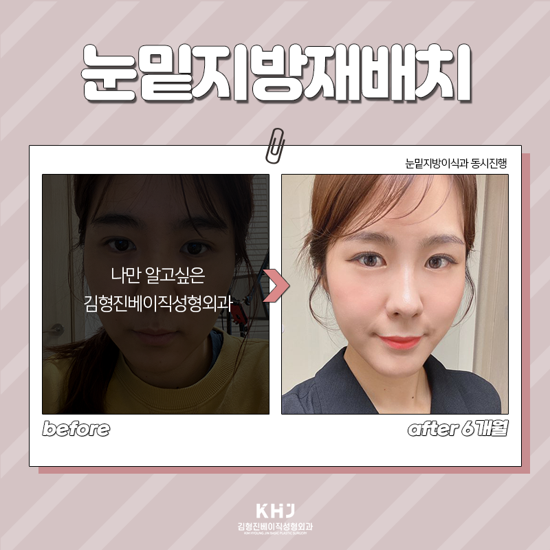 Take a look at the before-and-after of under-eye fat repositioning! image 6