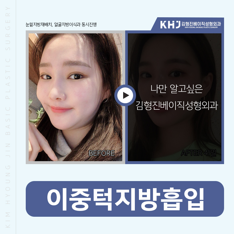 이중턱지방흡입처짐 걱정없어요! 관련 이미지 5