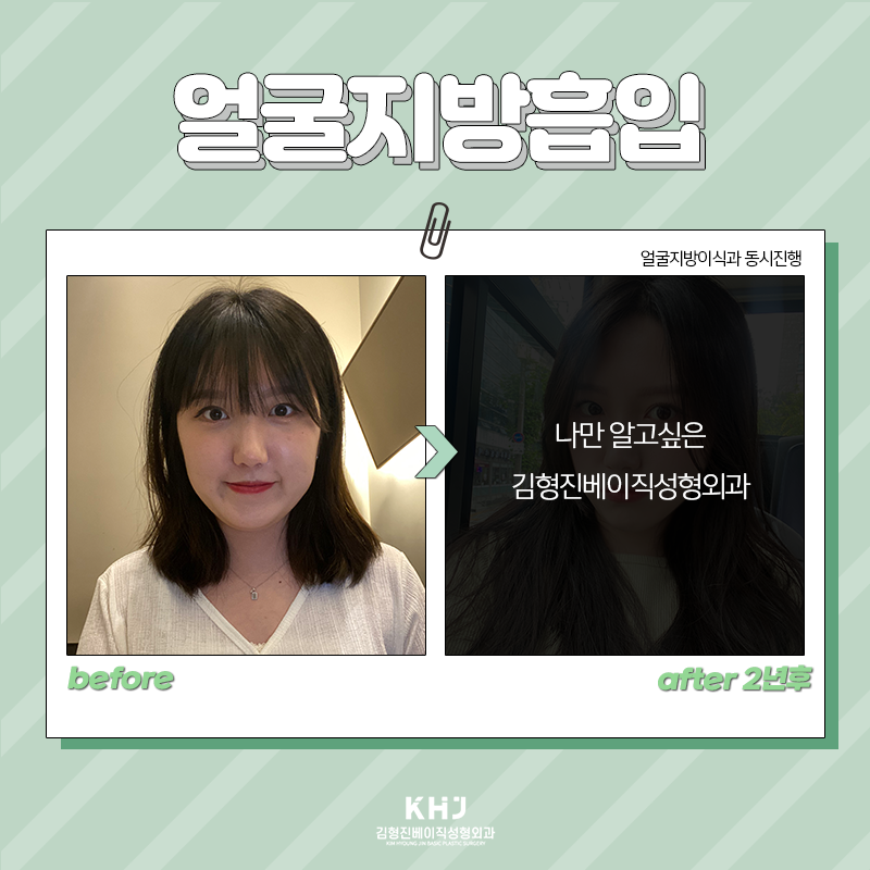 얼굴지방흡입붓기 걱정되신다구요? 관련 이미지 5