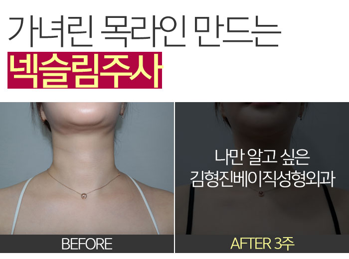 넥라인보톡스 진짜 해야 할때 (a.k.a 김형진베이직 넥슬림주사) 관련 이미지 8