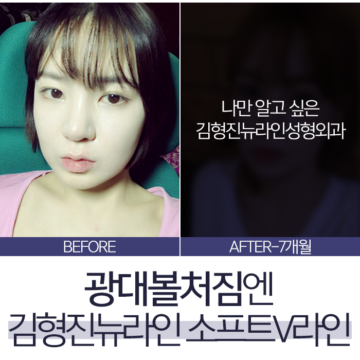 광대볼처짐 이렇게 해야 되요! 관련 이미지 5