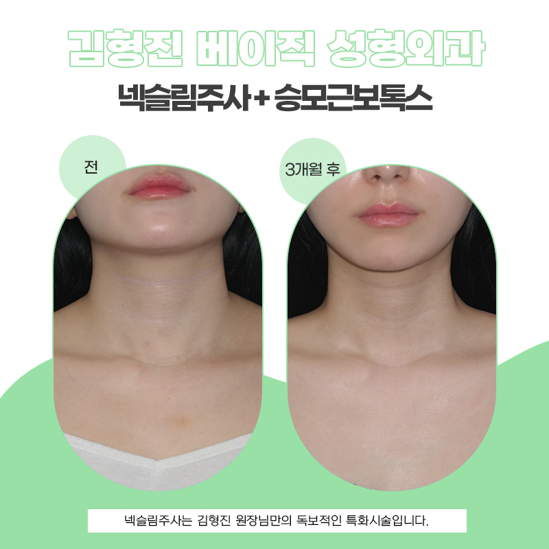 넥슬림주사전후 여리여리한 목 라인의 비결 관련 이미지 5