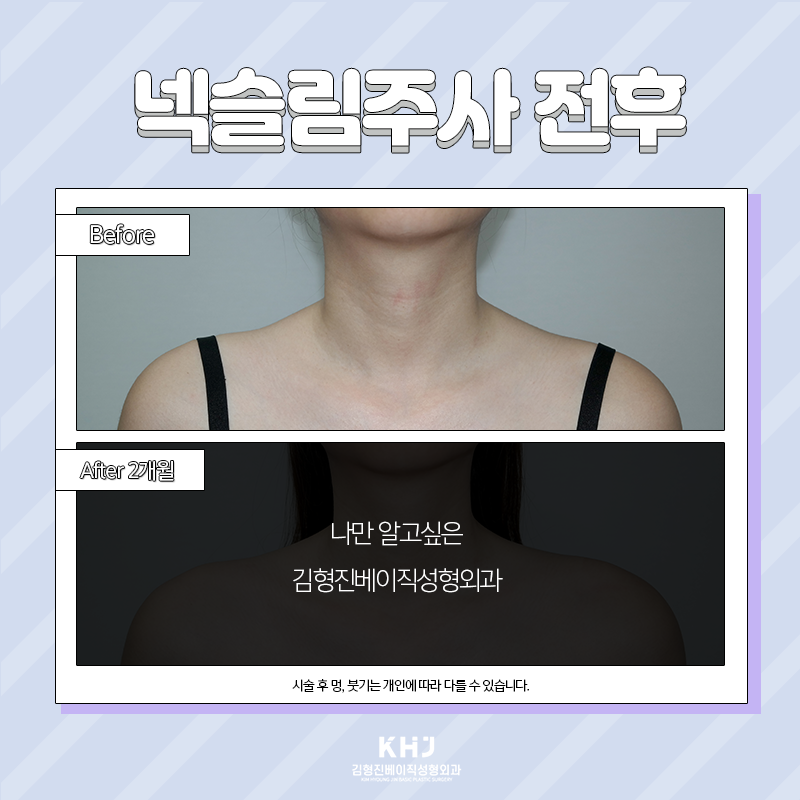 넥슬림주사전후 이렇게나 대단해! 관련 이미지 2