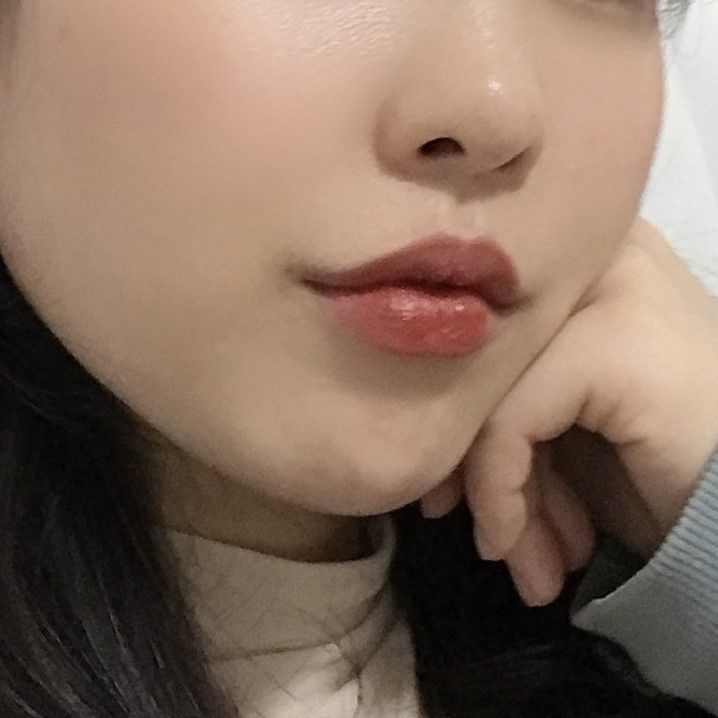 입꼬리시술로 자연스러운 미소라인 만드는 법 관련 이미지 3