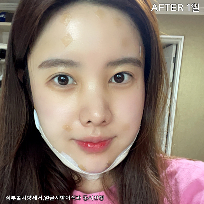 얼굴살제거 방법? 바로 알려드릴게요! 관련 이미지 3