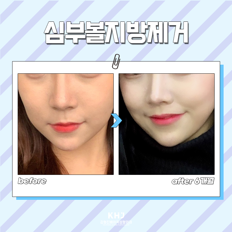 그동안 잘못 알고 있었던 볼살빼는법 관련 이미지 5