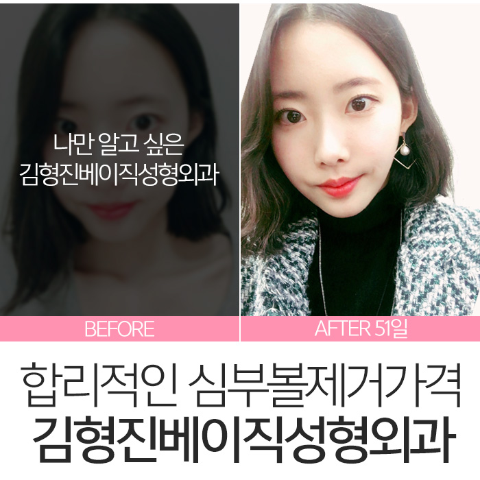심부볼지방제거가격 싼 곳 보다는 실력이 중요! 관련 이미지 2