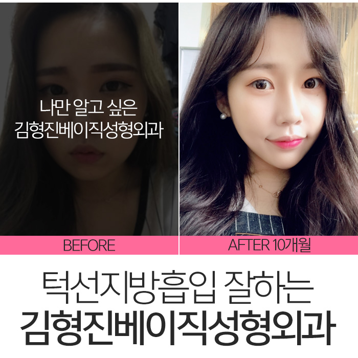 턱선지방흡입 김형진베이직성형외과 짜란다 관련 이미지 6