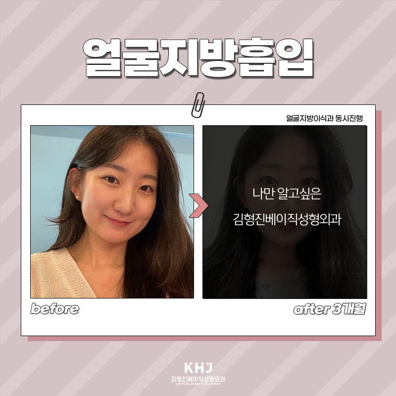 얼굴지방흡입전후 보고 가세요! 관련 이미지 6