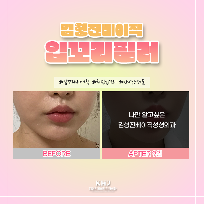 입꼬리필러전후 궁금하셨다면? 관련 이미지 3