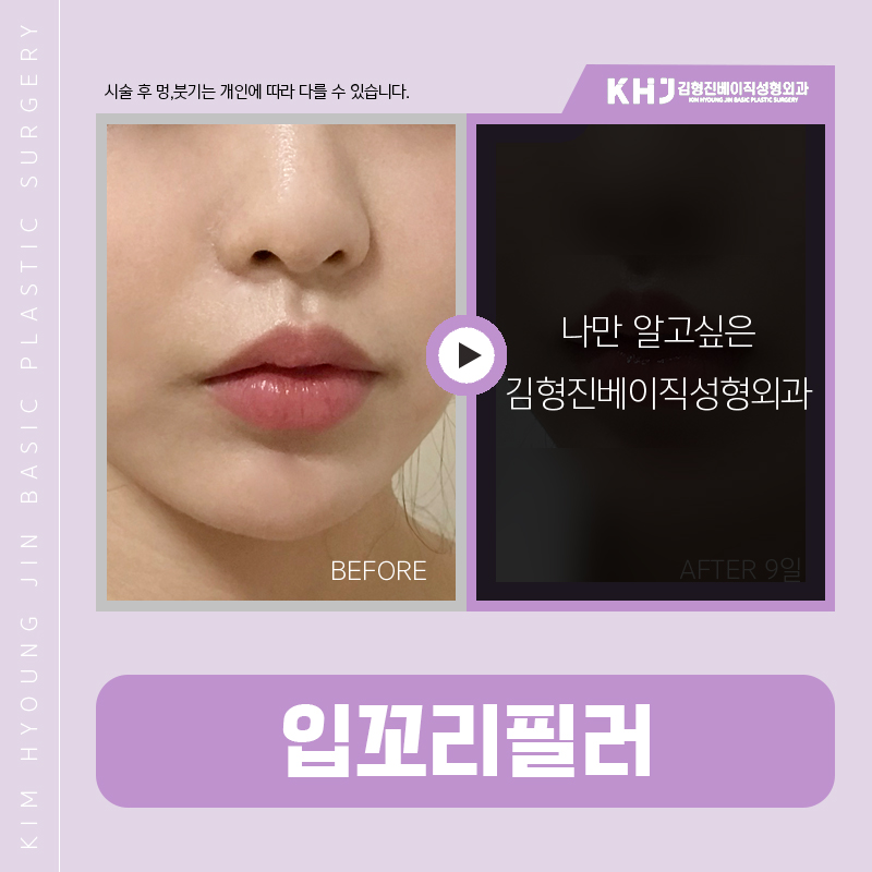 입꼬리올리는방법 진짜 알려드릴까요? 관련 이미지 7