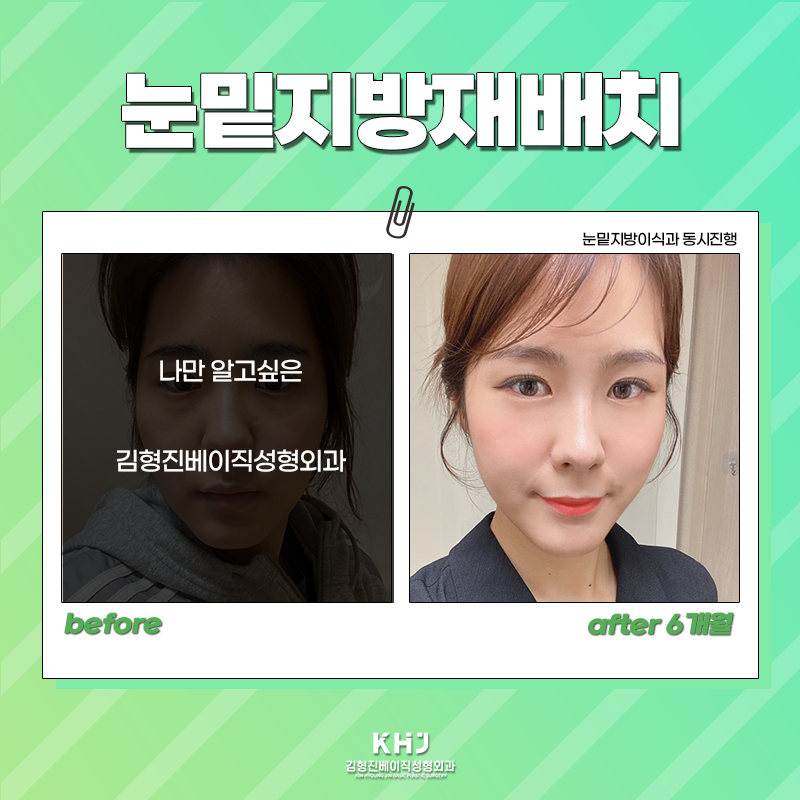 눈밑지방재배치전후 보러 오실래요~? 관련 이미지 3