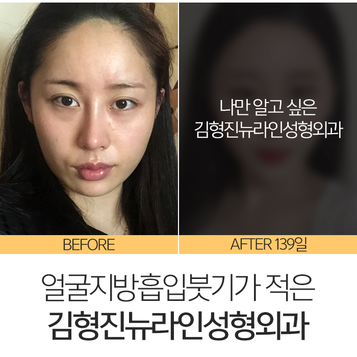얼굴지방흡입붓기 솔직히 없을 순 없어요 관련 이미지 8