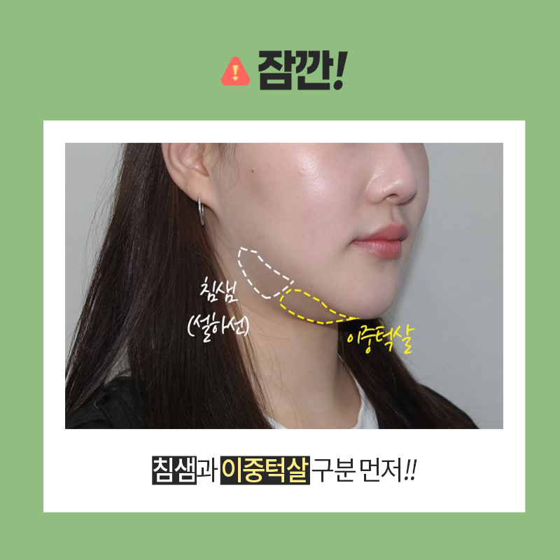 침샘보톡스주기 어떻게 되냐면요 관련 이미지 2