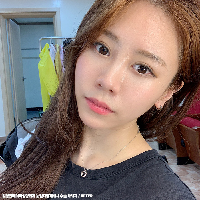 눈밑지방재배치후기 봐줄거죠? 관련 이미지 5