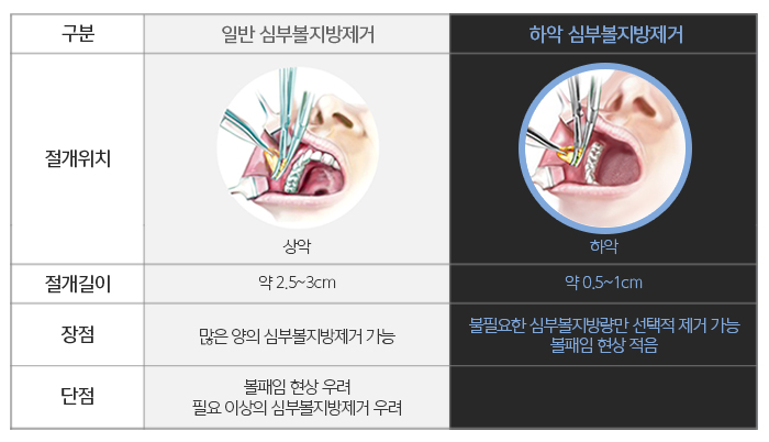 하악심부볼지방제거 보면 놀라요 관련 이미지 5