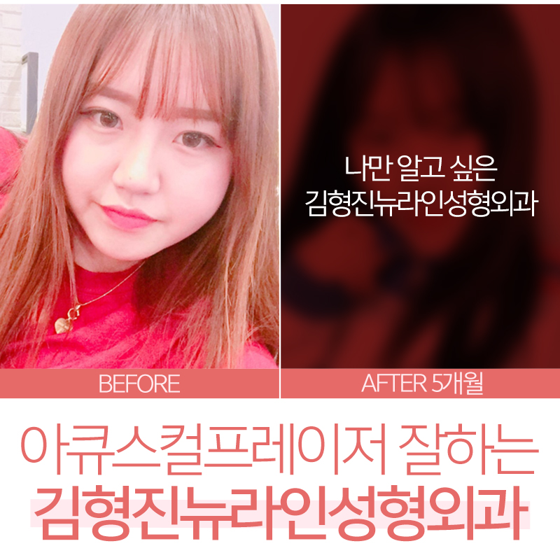 아큐스컬프레이저 어쩜 붓기가 없어? 관련 이미지 2
