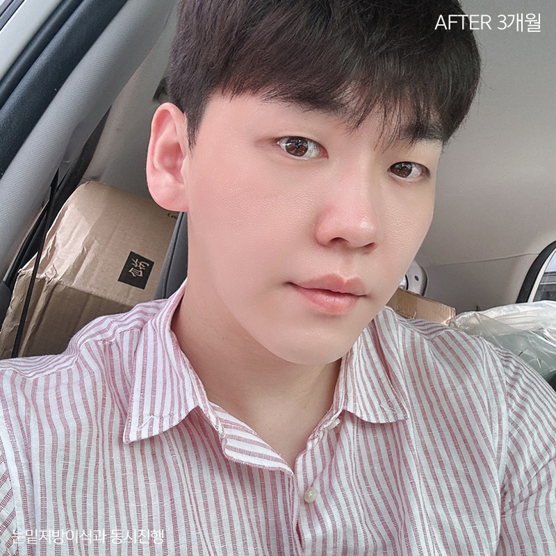 눈밑지방재배치잘하는병원 김형진베이직! 관련 이미지 4