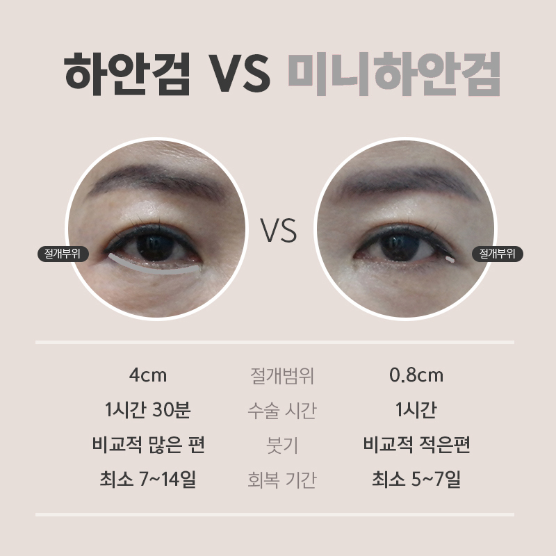 중년눈수술후기 진짜 어쩌면 좋죠? 관련 이미지 4