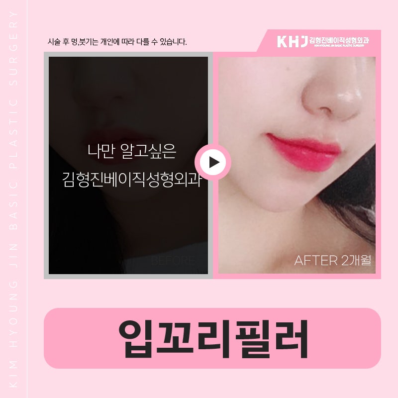 강남입꼬리필러 맛집, 입소문에는 다 이유가 있네요 관련 이미지 7