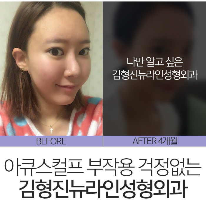 아큐스컬프부작용 걱정된다면 관련 이미지 7