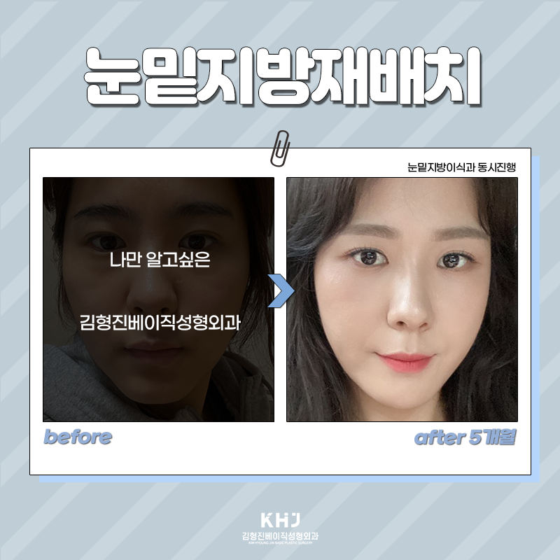 눈밑지방재배치수술 이젠 하셔야죠! 관련 이미지 6