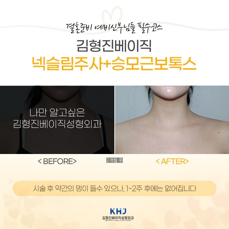 넥슬림주사효과 이런 목라인이 가능하네요..? 관련 이미지 7