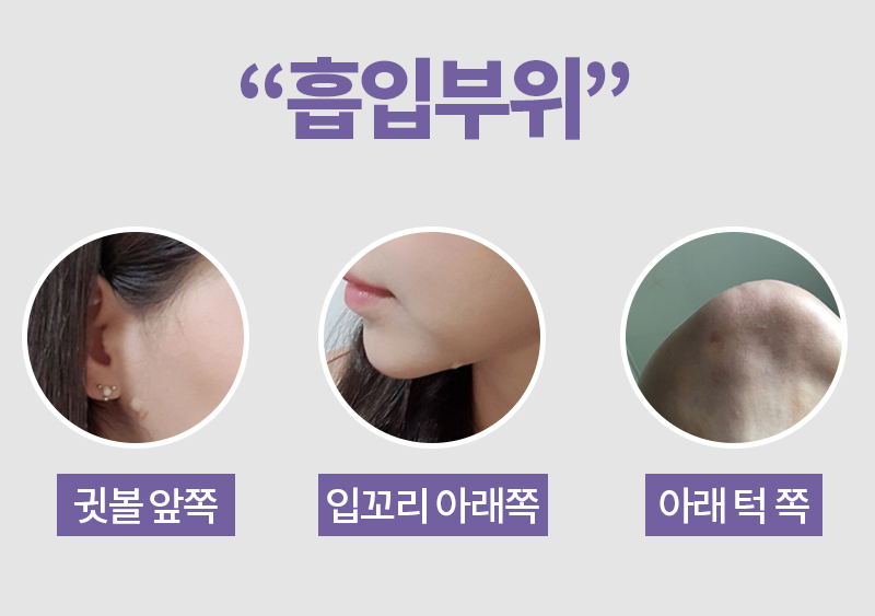 이중턱지방흡입흉터 안 보여요! 관련 이미지 5