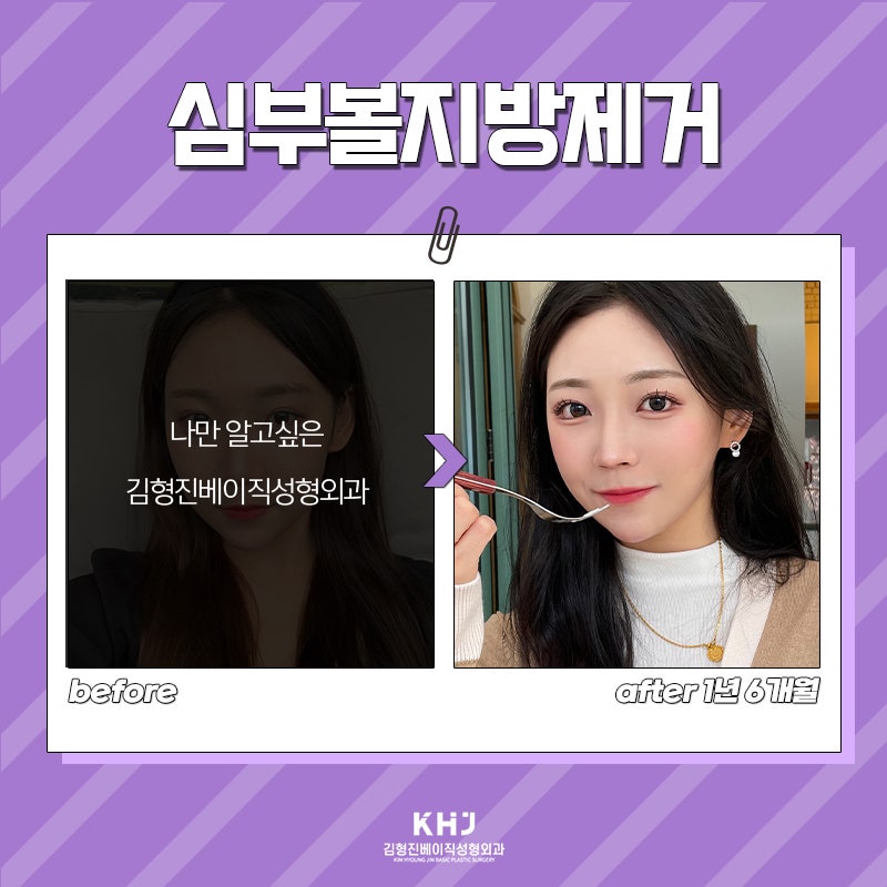 심부볼지방제거잘하는곳 돌고 돌아 여기네요 관련 이미지 5