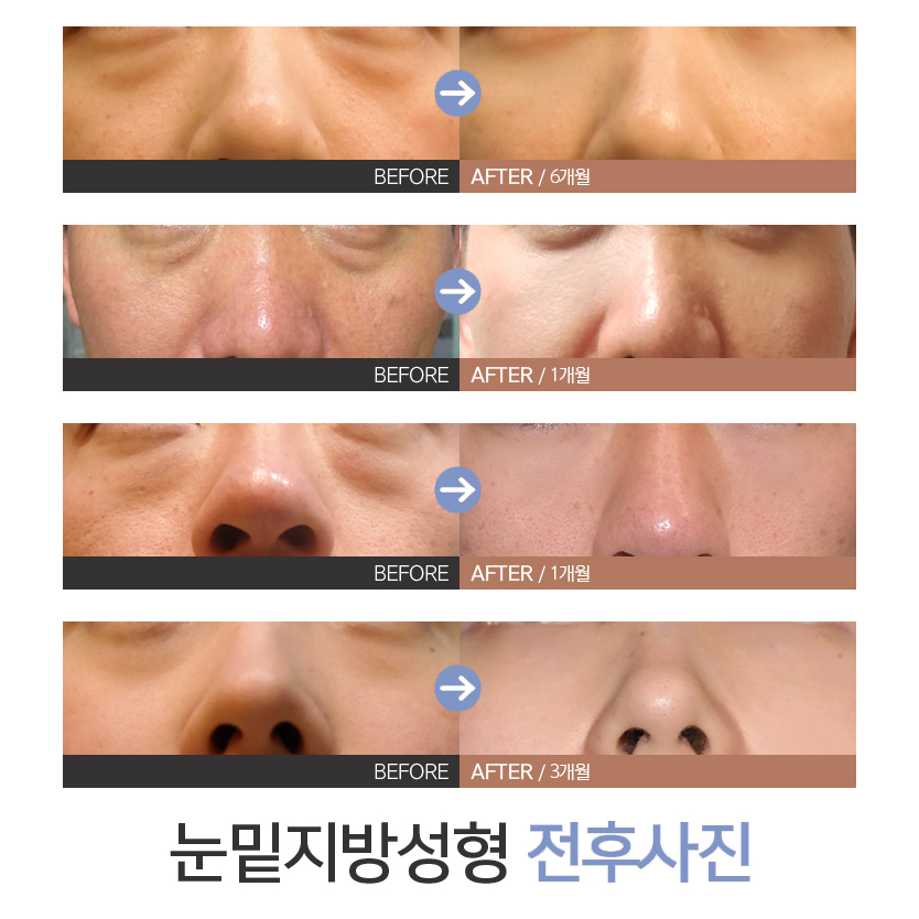 아직도 강남눈밑수술 잘하는 곳 못 찾았나요? 관련 이미지 6