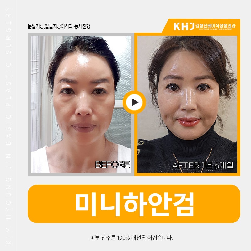 중년미니하안검으로 눈 밑 고민 해결했어요! 관련 이미지 5