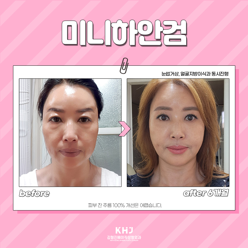 미니하안검효과에 만족할 수 밖에 없는 이유 관련 이미지 5