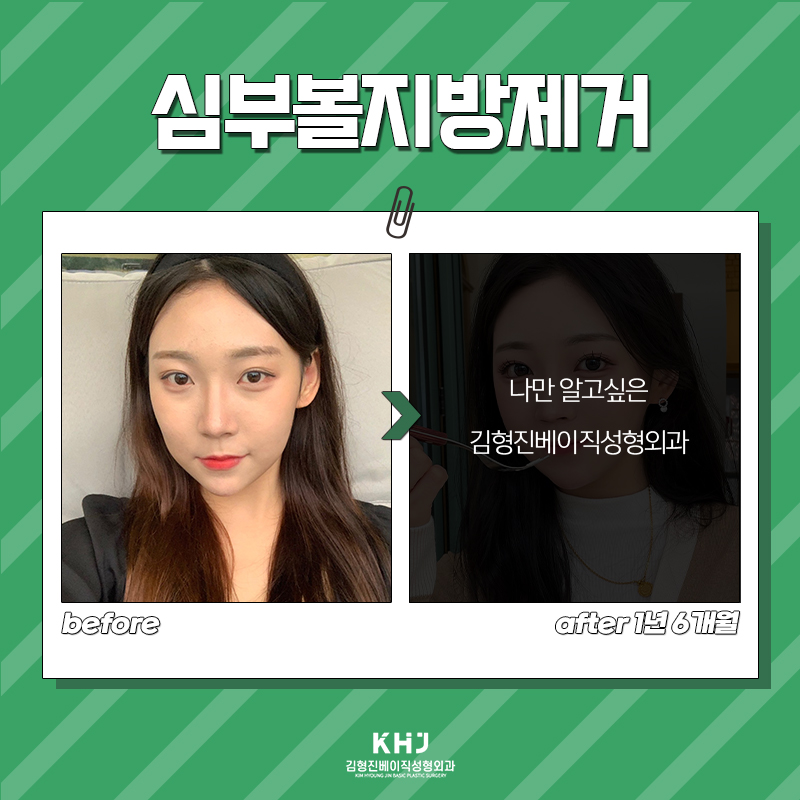 심부볼볼패임 때문에 망설이고 계신 분 들어오세요! 관련 이미지 6