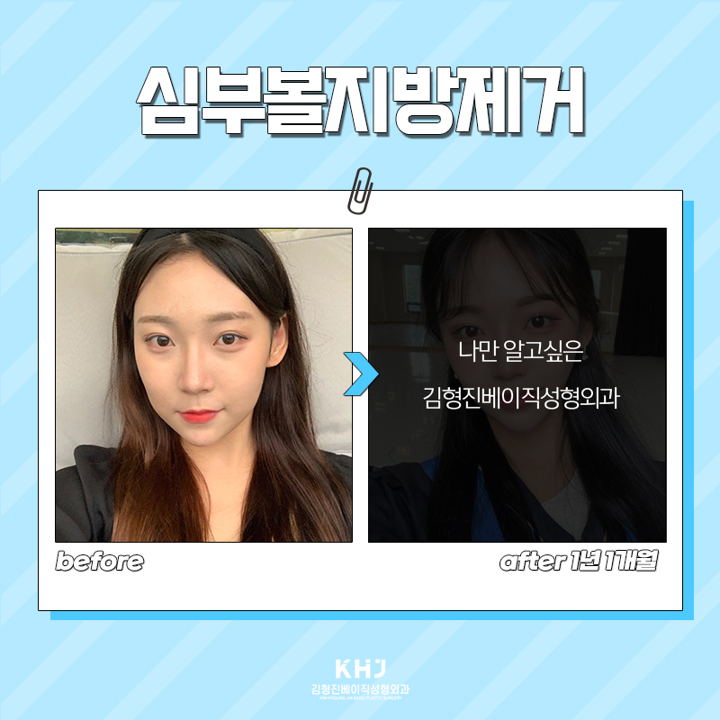 아직도 심부볼지방없애는법 고민하고 계신다면? 관련 이미지 5