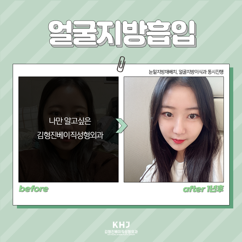 얼굴지방흡입붓기 걱정되신다구요? 관련 이미지 4