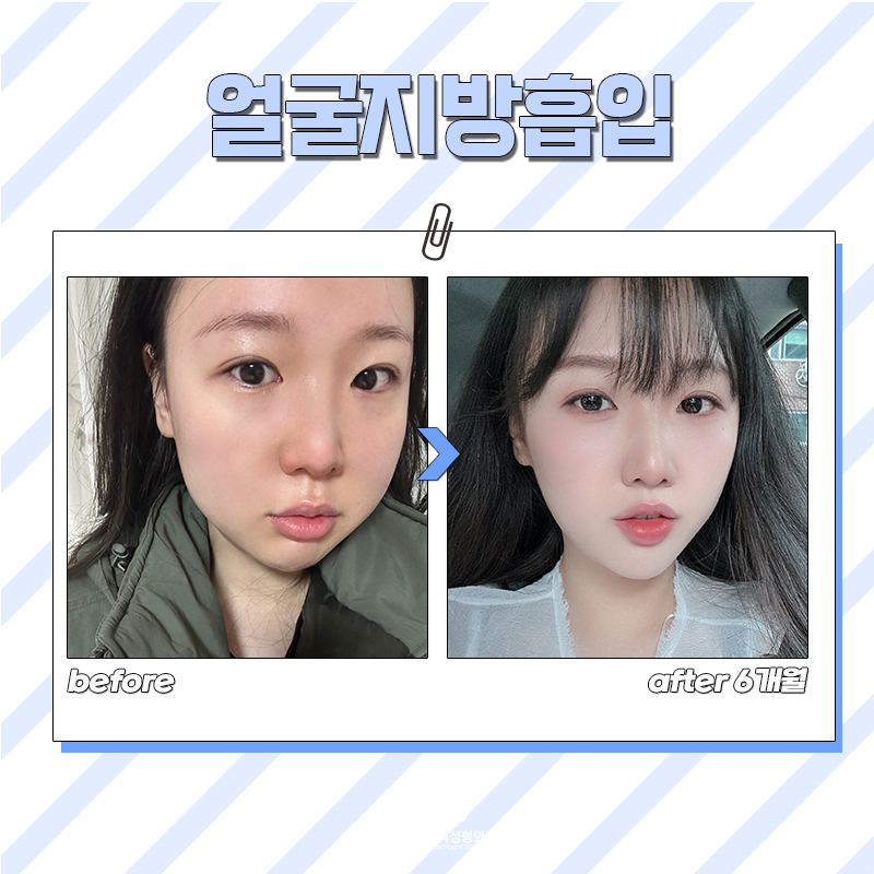 올해 가기 전에 얼굴살빼는수술 필요한 사람? 관련 이미지 6