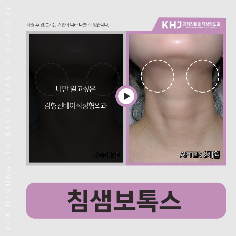 침샘보톡스후기 궁금하신분?? 관련 이미지 6