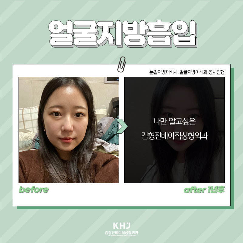 얼굴지방흡입붓기 걱정되신다구요? 관련 이미지 3