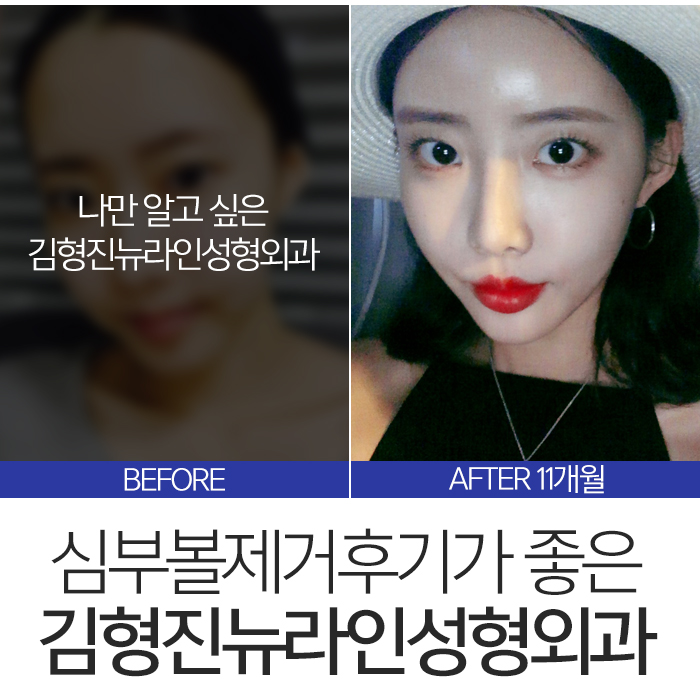 심부볼제거후기 좋을 수 밖에 없는 관련 이미지 7