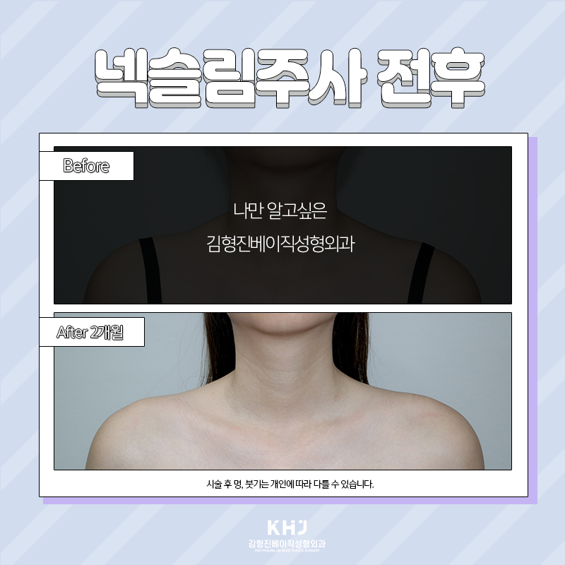 넥슬림주사전후 이렇게나 대단해! 관련 이미지 3