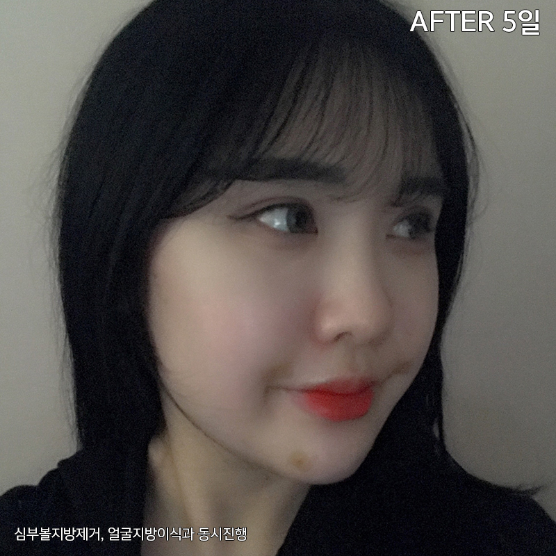 이중턱해결법 아직 모르신다구요? 관련 이미지 4