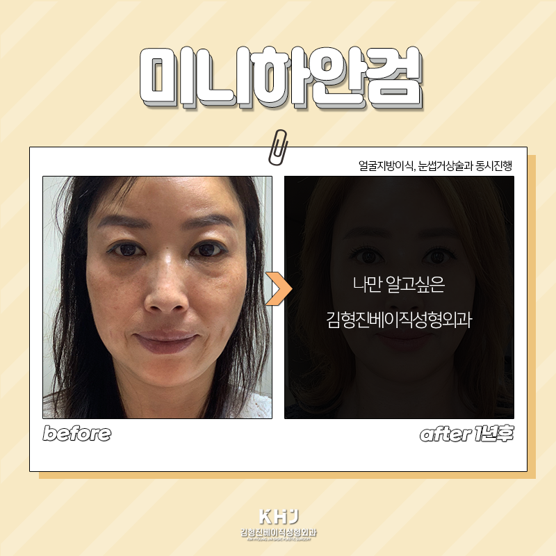 미니하안검흉터 걱정되시죠? 관련 이미지 3