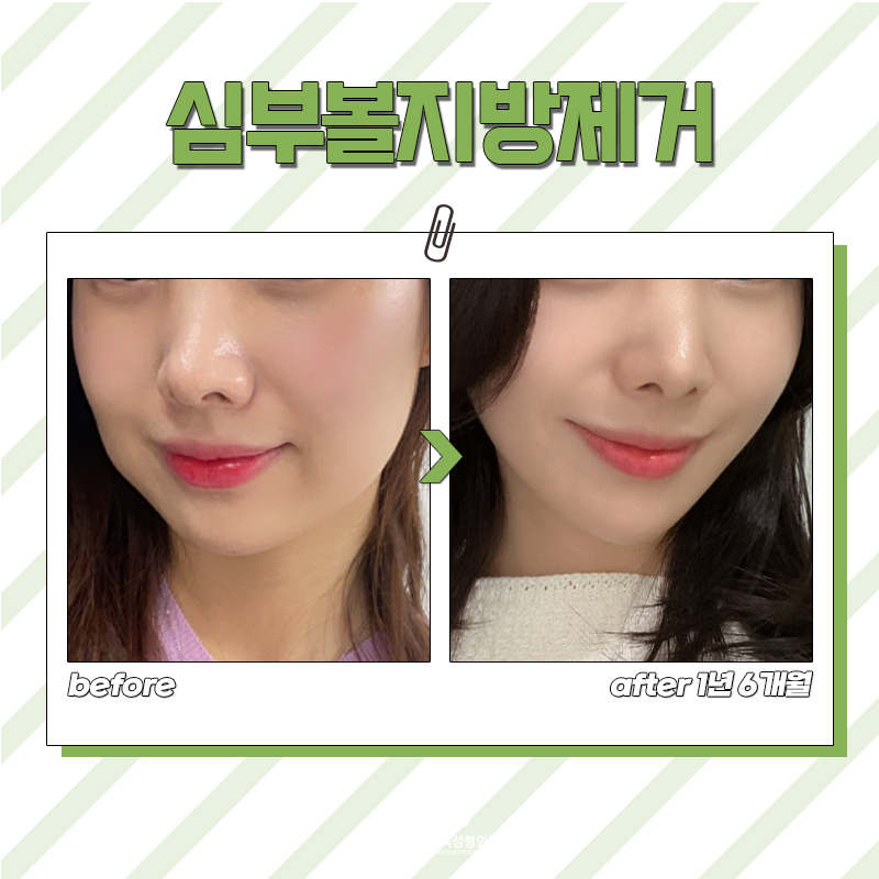 불독살제거,단순한 다이어트로는 어려운 이유 알고 계신가요? 관련 이미지 5