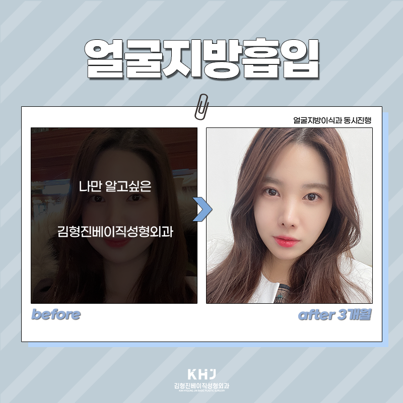 얼굴지방흡입수술 어떻게 진행되냐면요 관련 이미지 3