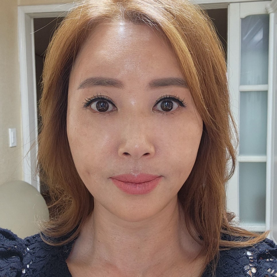 중년눈밑수술전후 잘하는 곳에서 하면 확실히 달라요 관련 이미지 1