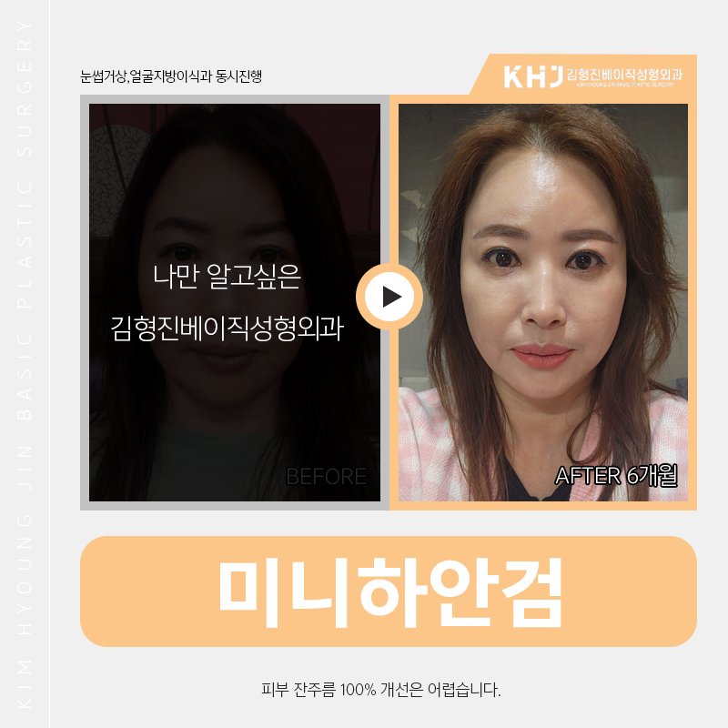 중년눈밑처짐 해결 원하신다면 김형진베이직에서! 관련 이미지 3