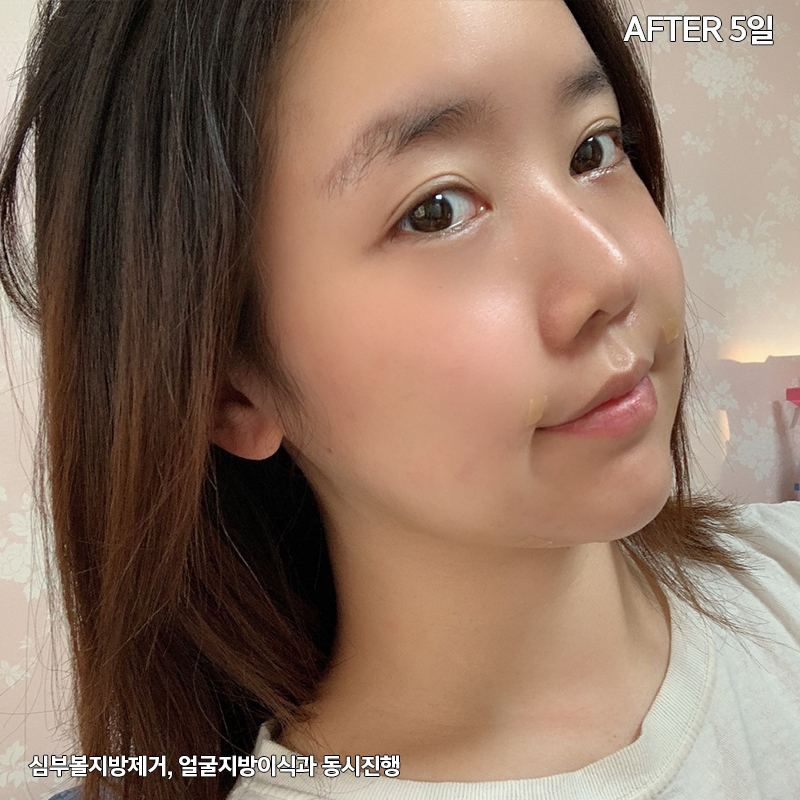 턱지방흡입 처짐 없는 김형진베이직 관련 이미지 4