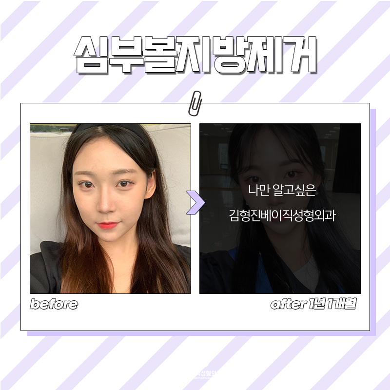 강남심부볼제거 볼살만 쏙 빼주니까 만족할 수 밖에 없죠 관련 이미지 5