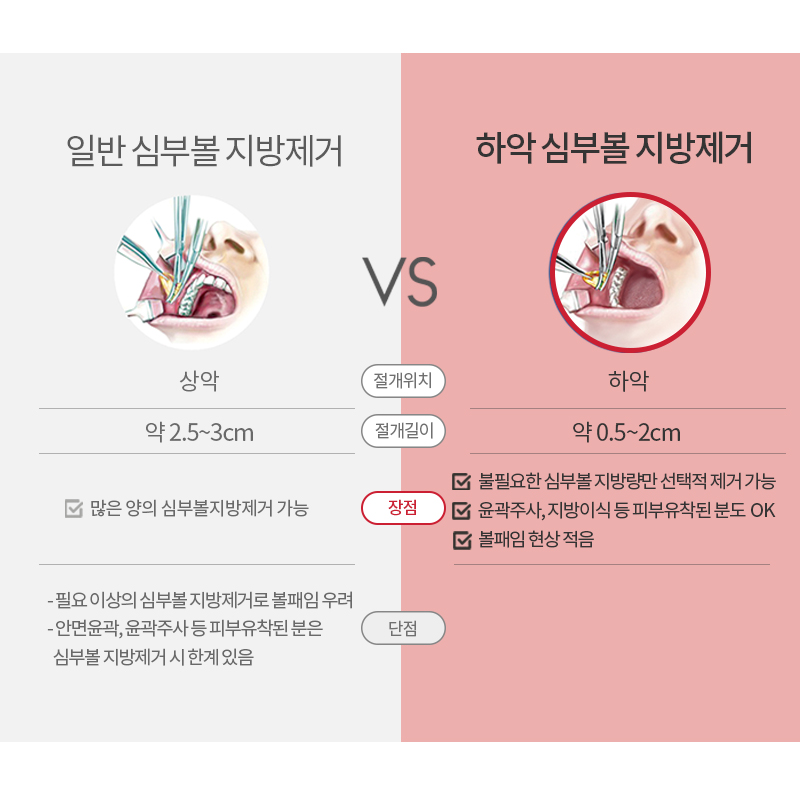 심부볼지방제거수술로 처진 불독살 개선 끝 관련 이미지 6
